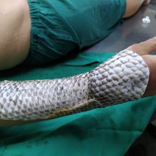 Tratamento queimadura pele de tilápia